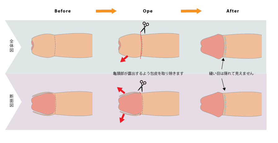 環状切除術の説明図